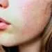 extremely dry skin